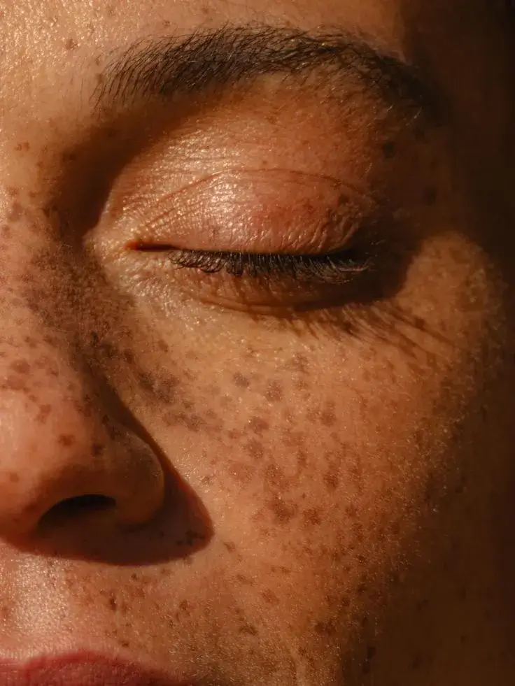 Sun-Damaged Skin
